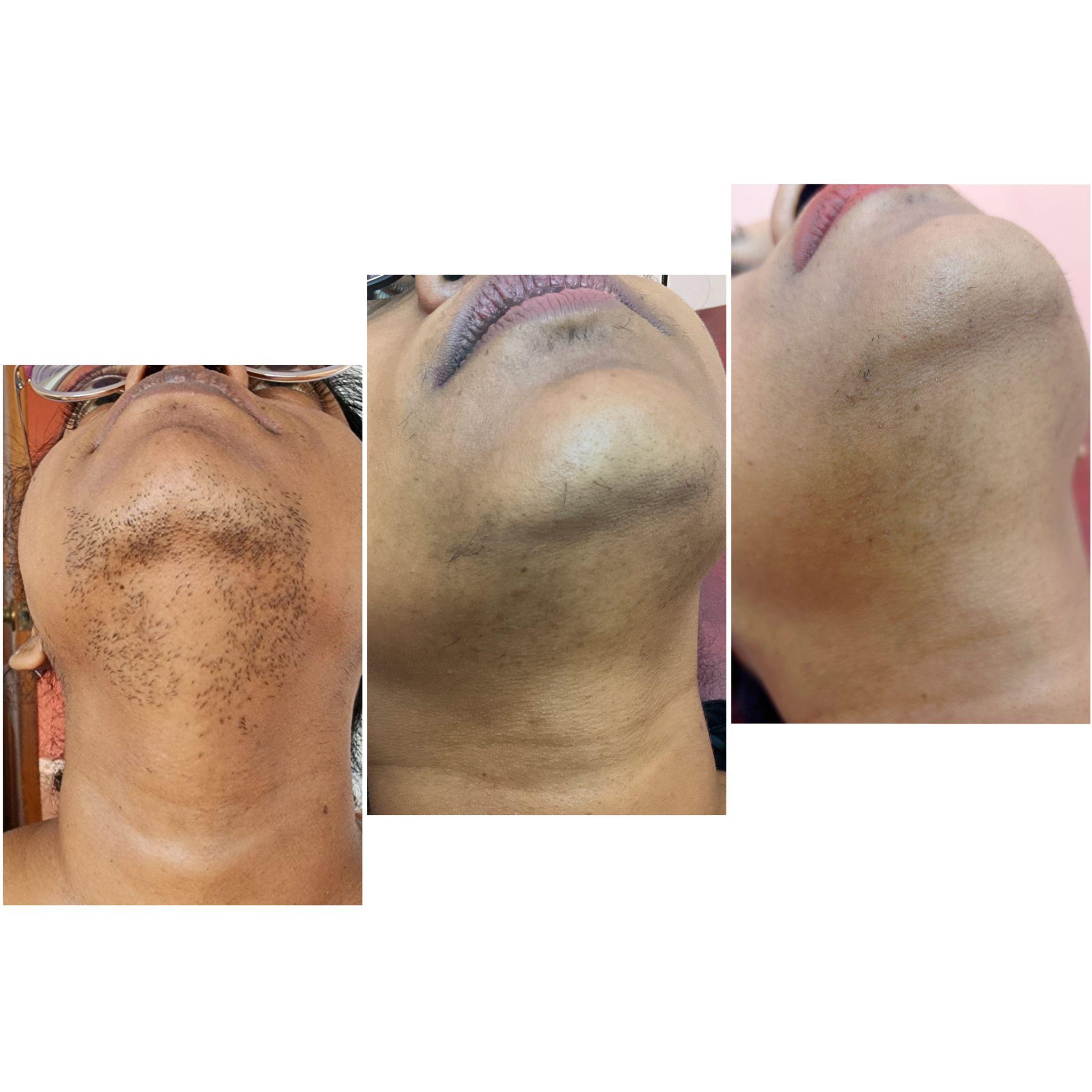 Laser Hair Removal client result 1