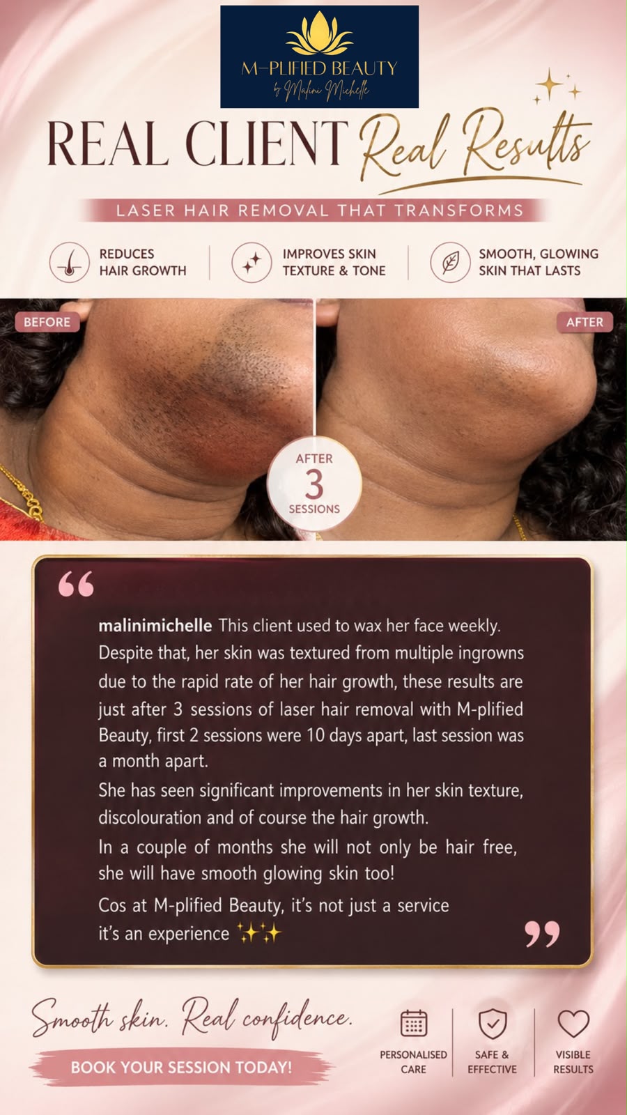 Laser Hair Removal client result 3