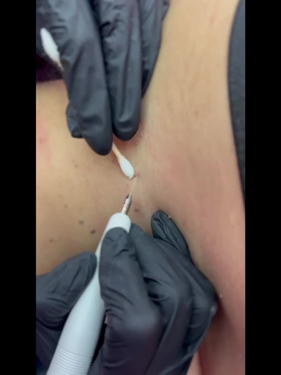 Skin tag removal treatment at M-Plified Beauty Singapore